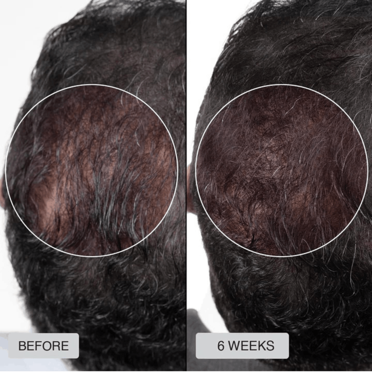 Red Light Therapy Cap for Hair Regrowth Treatments